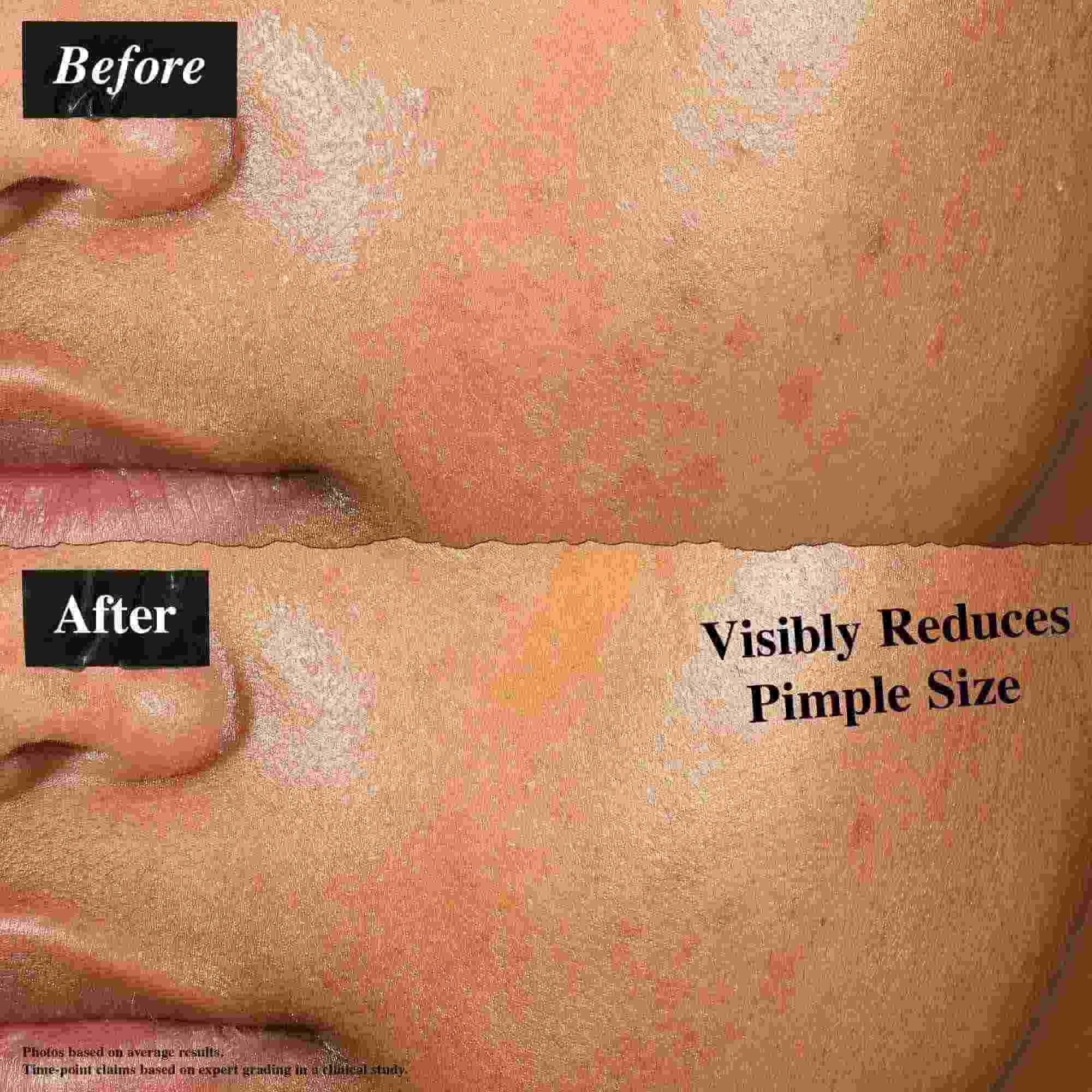 Usporedba prije i poslije koja prikazuje kožu tretiranu Truly-Targeted Blemish-Clearing Solutionom. Slika "prije" prikazuje vidljive prištiće, dok slika "poslije" prikazuje smanjenu veličinu prištića.