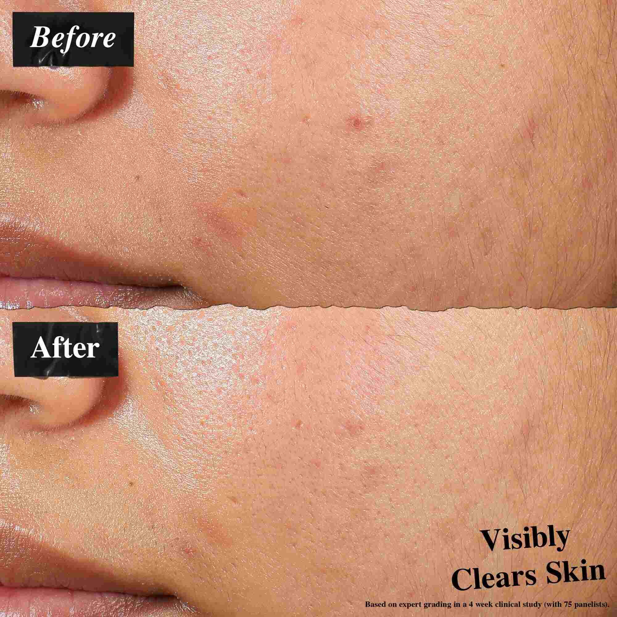 Usporedba prije i poslije koja prikazuje kožu tretiranu Expertly Clear Blemish-Treating & Preventing Lotion. Slika „prije” prikazuje nepravilnosti i neujednačenu teksturu kože, dok slika „poslije” prikazuje vidljivo čišću kožu.