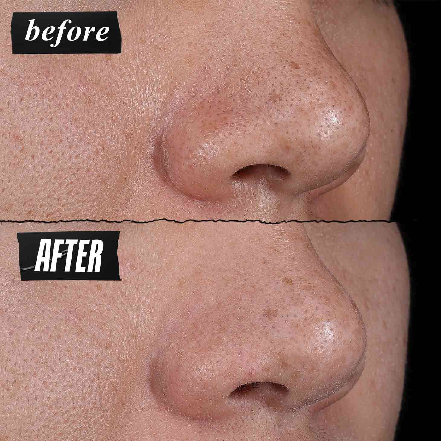 Fotografija Prije i Poslije – Kiehl's Rare Earth maska za dubinsko čišćenje pora vidljivo smanjuje pore