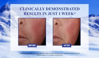Alt text: Two side-by-side images of a person's cheek, labeled "Before" on the left and "After" on the right, showing improved skin tone and evenness after one week of treatment, with a snowy mountain background.