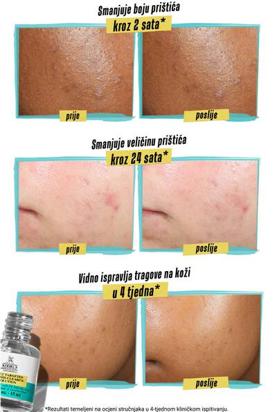 Alt text: A comparison image showing the effects of a skincare product on acne. The top two panels show before and after results of reduced pimple color in 2 hours, with noticeable color improvement. The middle panels depict before and after results of reduced pimple size in 24 hours, showing smaller pimples after treatment. The bottom panels illustrate before